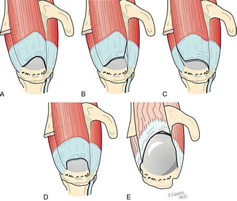 Rotator cuff repair: Tear classification, operative techniques, and 